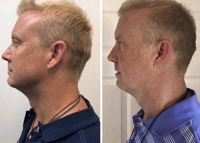 jawline exercise before after