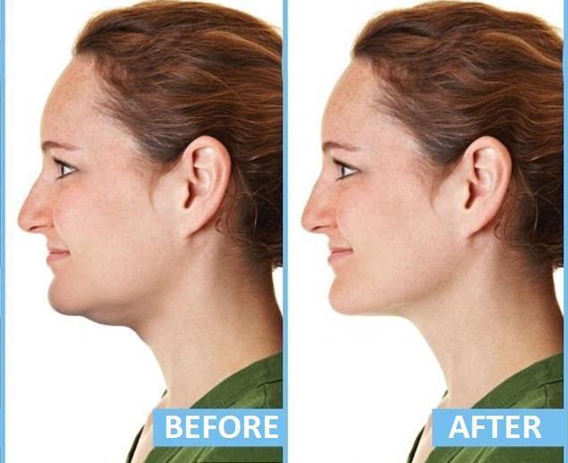 Jaw exercise ball to reduce double chin face workout before after