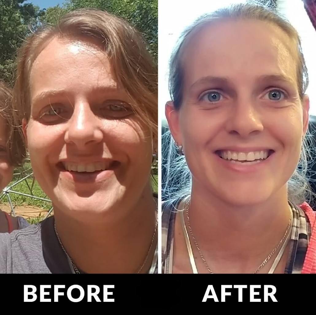 jaw exercise before and after